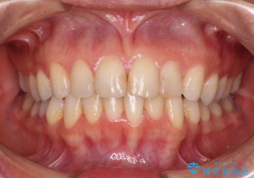 前歯の叢生をいつの間にか改善　インビザラインによる矯正治療の治療後
