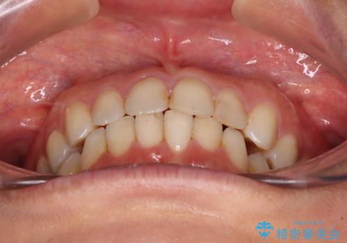 前歯の叢生をいつの間にか改善 インビザラインによる矯正治療の治療後