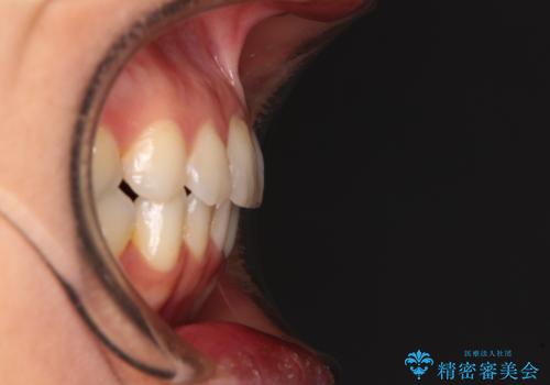 前歯の叢生をいつの間にか改善 インビザラインによる矯正治療の治療後