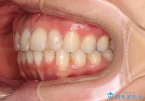 前歯の叢生をいつの間にか改善　インビザラインによる矯正治療の治療後