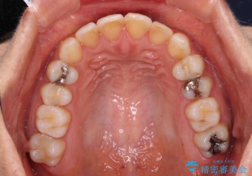 前歯の叢生をいつの間にか改善 インビザラインによる矯正治療の治療後