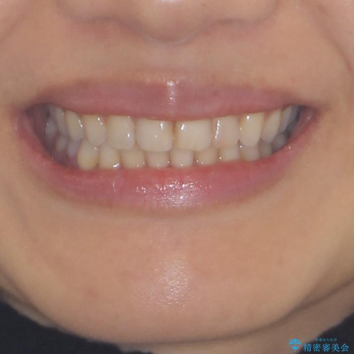 前歯の叢生をいつの間にか改善　インビザラインによる矯正治療の治療後（顔貌）