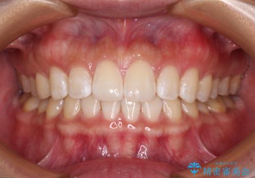 【モニター】前歯のすきっ歯をインビザラインで改善の症例 治療後