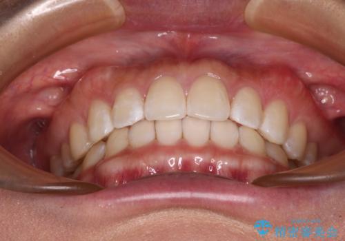 【モニター】前歯のすきっ歯をインビザラインで改善の治療後