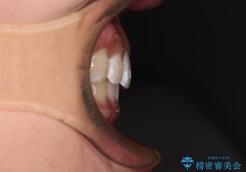 【モニター】前歯のすきっ歯をインビザラインで改善の治療後