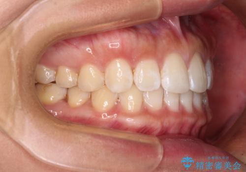 【モニター】前歯のすきっ歯をインビザラインで改善の治療後