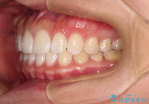 【モニター】前歯のすきっ歯をインビザラインで改善の治療後