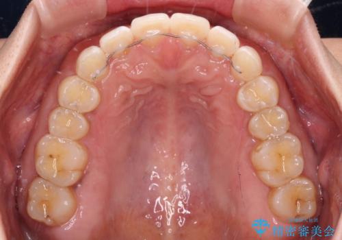 【モニター】前歯のすきっ歯をインビザラインで改善の治療後