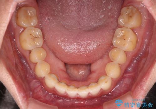 【モニター】前歯のすきっ歯をインビザラインで改善の治療後