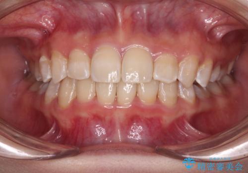 楽してクロスバイトを治したい ワイヤー装置による矯正治療の症例 治療後