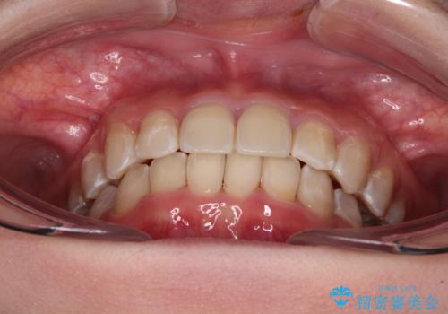 楽してクロスバイトを治したい ワイヤー装置による矯正治療の治療後