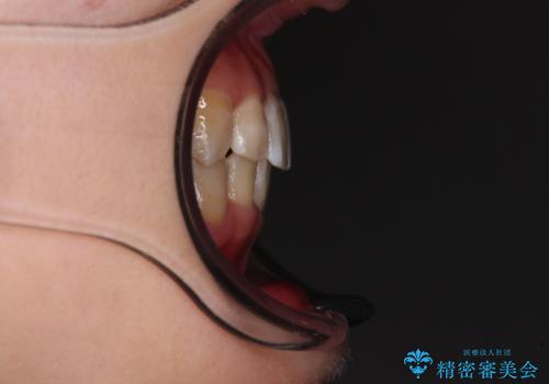 楽してクロスバイトを治したい ワイヤー装置による矯正治療の治療後