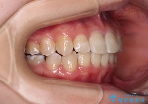 楽してクロスバイトを治したい ワイヤー装置による矯正治療の治療後