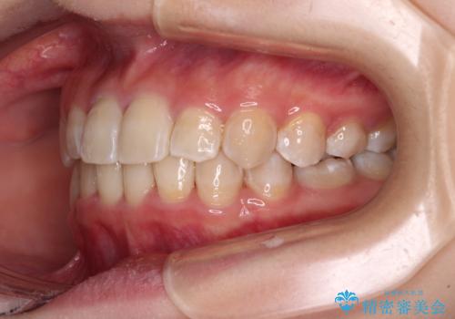 楽してクロスバイトを治したい ワイヤー装置による矯正治療の治療後