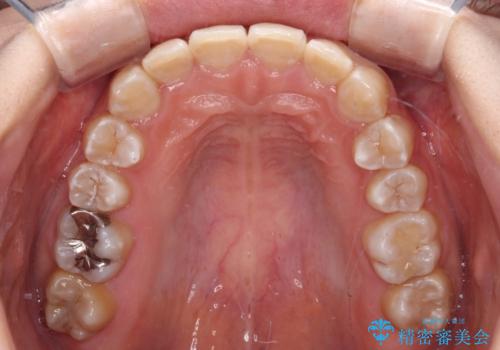 楽してクロスバイトを治したい ワイヤー装置による矯正治療の治療後