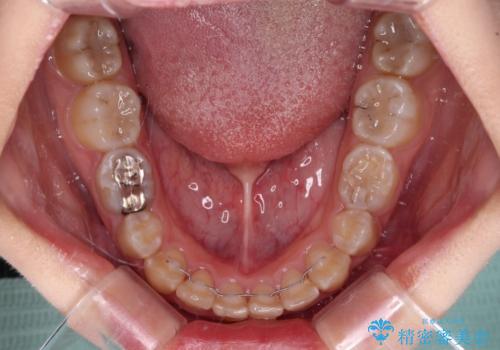 楽してクロスバイトを治したい ワイヤー装置による矯正治療の治療後