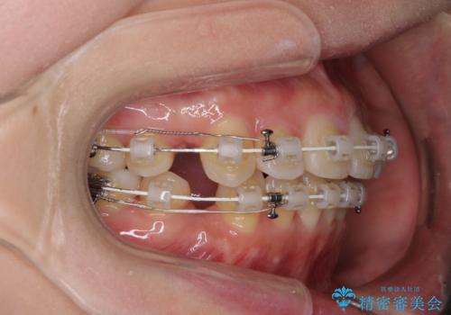 出っ歯を改善　目立たないワイヤー装置での抜歯矯正の治療中