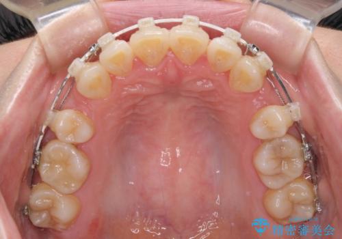 出っ歯を改善　目立たないワイヤー装置での抜歯矯正の治療中