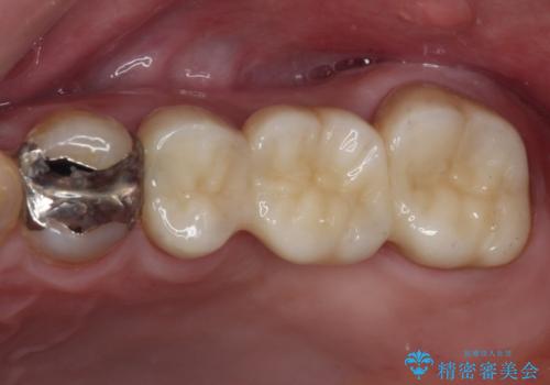 欠損と痛み　奥歯のむし歯治療の症例 治療後
