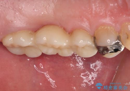 欠損と痛み 奥歯のむし歯治療の治療後