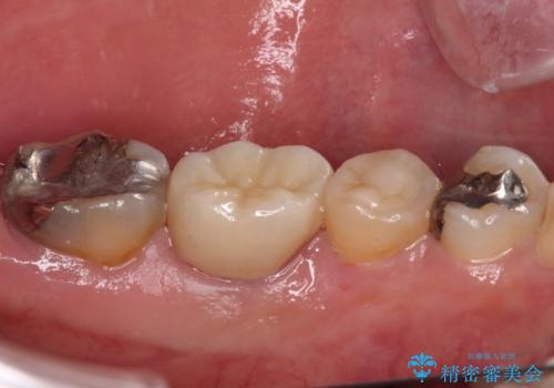 欠損と痛み　奥歯のむし歯治療の治療後
