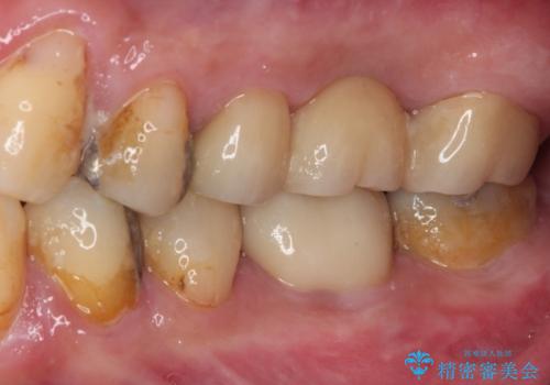 欠損と痛み 奥歯のむし歯治療の治療後