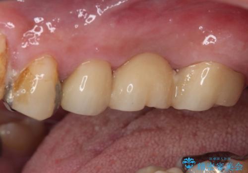 欠損と痛み 奥歯のむし歯治療の治療後