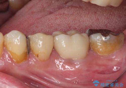 欠損と痛み　奥歯のむし歯治療の治療後