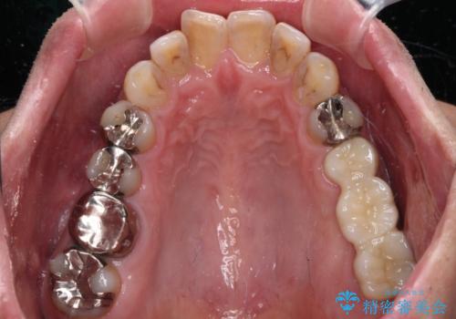 欠損と痛み 奥歯のむし歯治療の治療後