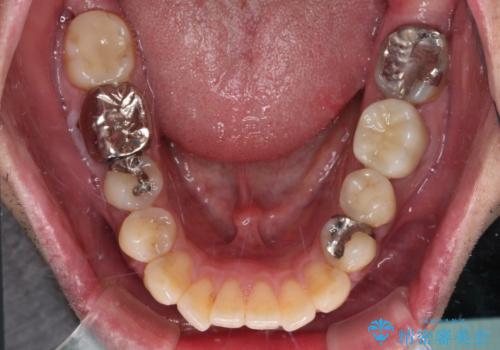 欠損と痛み 奥歯のむし歯治療の治療後