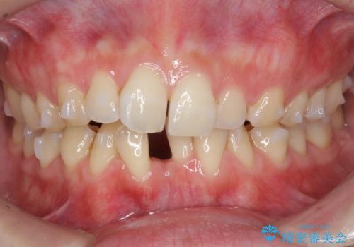 前歯のガタつき　インビザラインで　下の前歯を1本抜歯の治療中