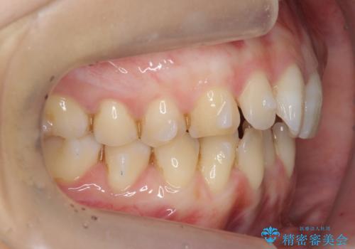 前歯のガタつき インビザラインで 下の前歯を1本抜歯の治療中