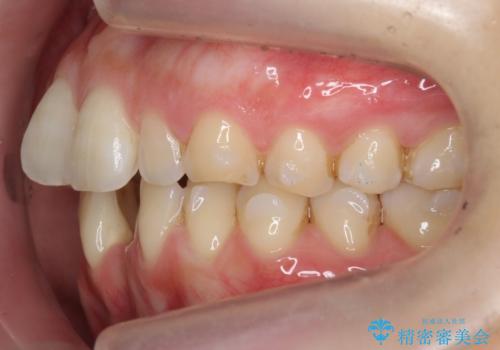 前歯のガタつき　インビザラインで　下の前歯を1本抜歯の治療中