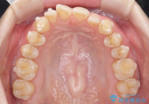 前歯のガタつき インビザラインで 下の前歯を1本抜歯の治療中