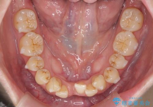 前歯のガタつき インビザラインで 下の前歯を1本抜歯の治療中