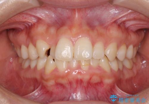 前歯のクロスバイト 目立たないワイヤー装置で速やかに矯正治療の治療前