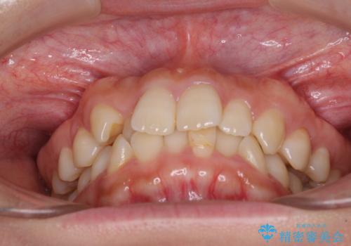 前歯のクロスバイト　目立たないワイヤー装置で速やかに矯正治療の治療前