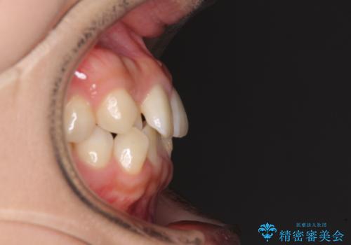 前歯のクロスバイト 目立たないワイヤー装置で速やかに矯正治療の治療前