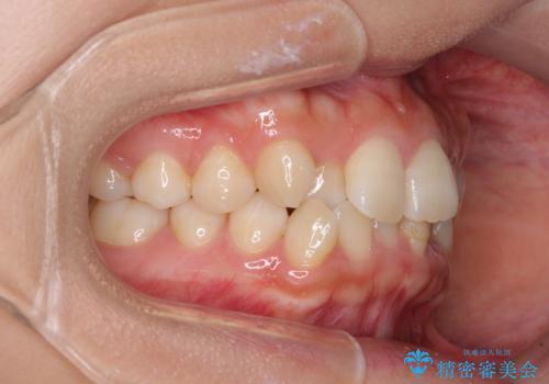 前歯のクロスバイト 目立たないワイヤー装置で速やかに矯正治療の治療前