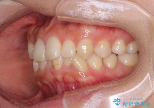 前歯のクロスバイト 目立たないワイヤー装置で速やかに矯正治療の治療前