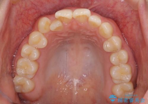 前歯のクロスバイト 目立たないワイヤー装置で速やかに矯正治療の治療前