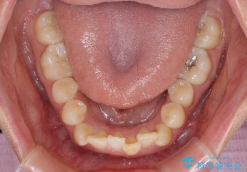 前歯のクロスバイト 目立たないワイヤー装置で速やかに矯正治療の治療前