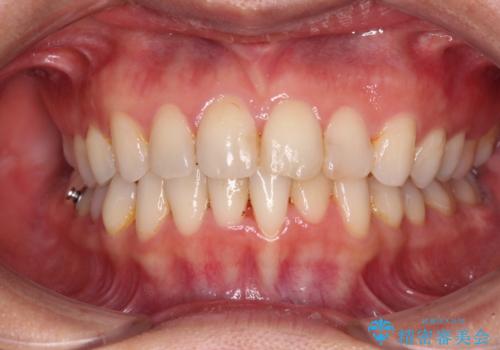 前歯の叢生をいつの間にか改善 インビザラインによる矯正治療の治療中