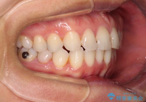 前歯の叢生をいつの間にか改善 インビザラインによる矯正治療の治療中