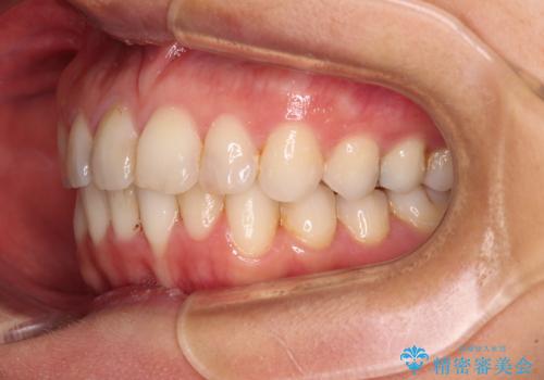 前歯の叢生をいつの間にか改善　インビザラインによる矯正治療の治療中