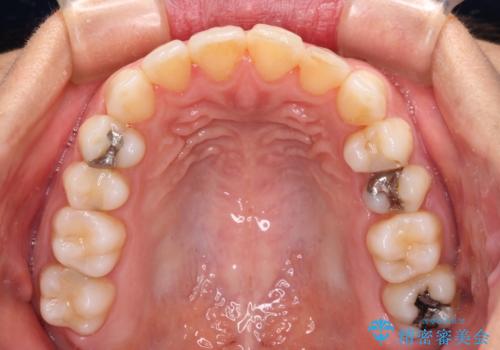 前歯の叢生をいつの間にか改善 インビザラインによる矯正治療の治療中