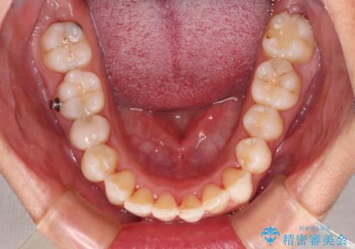 前歯の叢生をいつの間にか改善　インビザラインによる矯正治療の治療中