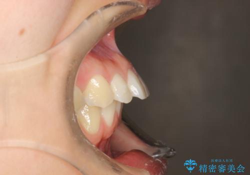 出っ歯の矯正　抜歯をしてしっかり引っ込めるワイヤー矯正の治療前