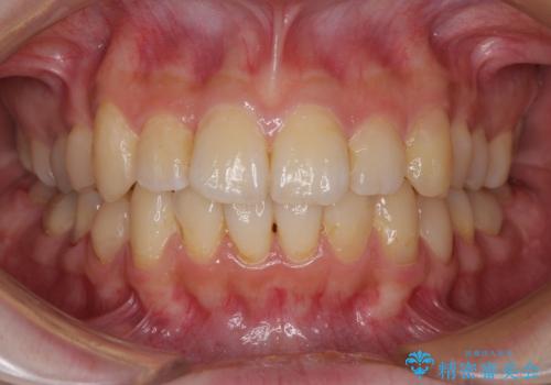 デコボコ歯列をきれいに インビザラインによる矯正治療の治療中