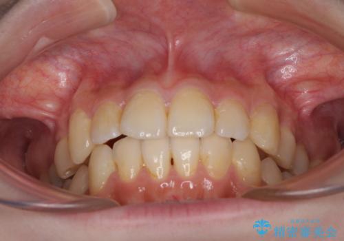 デコボコ歯列をきれいに インビザラインによる矯正治療の治療中